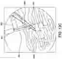 Fig. 21 - Chevron osteotomy tools and methods