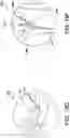 Fig. 25 - Chevron osteotomy tools and methods