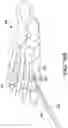 Fig. 27 - Chevron osteotomy tools and methods