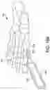 Fig. 28 - Chevron osteotomy tools and methods