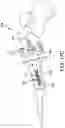 Fig. 31 - Chevron osteotomy tools and methods