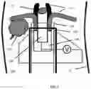 Fig. 05 - Electrically controllable surgical tools