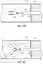 Fig. 04 - Retrograde Blood Flow Occlusion Flushing Device