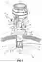 Fig. 04 - Surgical access device with fixation mechanism and illumination mechanism