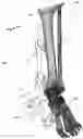 Fig. 50 - CLAMPING DEVICES FOR EXTERNAL FIXATION DEVICE