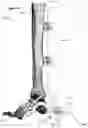 Fig. 51 - CLAMPING DEVICES FOR EXTERNAL FIXATION DEVICE