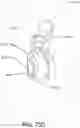 Fig. 60 - CLAMPING DEVICES FOR EXTERNAL FIXATION DEVICE