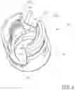 Fig. 05 - MODULAR TENSIONED SPINAL SCREW