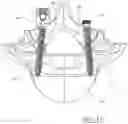 Fig. 11 - MODULAR TENSIONED SPINAL SCREW