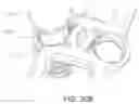 Fig. 36 - Anterior cervical plate assembly