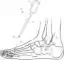 Fig. 01 - ENHANCED ORTHOPEDIC SCREW