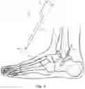 Fig. 02 - ENHANCED ORTHOPEDIC SCREW