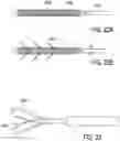 Fig. 24 - BONE IMPLANTS FOR THE TREATMENT OF INFECTION