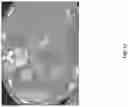 Fig. 18 - DEVICES, SYSTEMS, AND METHODS FOR CRYOABLATION