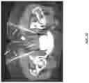 Fig. 21 - DEVICES, SYSTEMS, AND METHODS FOR CRYOABLATION