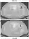 Fig. 22 - DEVICES, SYSTEMS, AND METHODS FOR CRYOABLATION