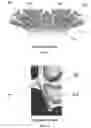 Fig. 02 - Zygomatic implant with partially interrupted threaded portion