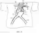 Fig. 14 - MODULAR BRANCHED ENDOPROSTHETIC SYSTEMS, DEVICES, AND METHODS