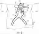 Fig. 21 - MODULAR BRANCHED ENDOPROSTHETIC SYSTEMS, DEVICES, AND METHODS