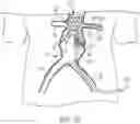 Fig. 22 - MODULAR BRANCHED ENDOPROSTHETIC SYSTEMS, DEVICES, AND METHODS