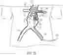 Fig. 23 - MODULAR BRANCHED ENDOPROSTHETIC SYSTEMS, DEVICES, AND METHODS