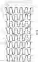 Fig. 03 - STENTS WITH INCREASED FLEXIBILITY