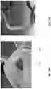 Fig. 27 - STENTS WITH INCREASED FLEXIBILITY