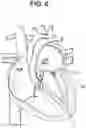 Fig. 07 - Prosthetic valves and related inventions
