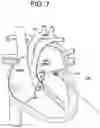 Fig. 08 - Prosthetic valves and related inventions