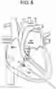 Fig. 09 - Prosthetic valves and related inventions