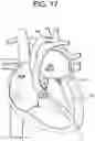 Fig. 19 - Prosthetic valves and related inventions