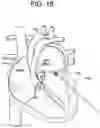 Fig. 20 - Prosthetic valves and related inventions