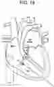 Fig. 21 - Prosthetic valves and related inventions