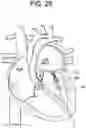 Fig. 27 - Prosthetic valves and related inventions