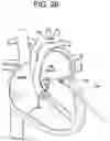 Fig. 28 - Prosthetic valves and related inventions