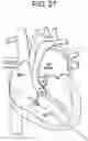 Fig. 29 - Prosthetic valves and related inventions