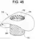 Fig. 41 - Prosthetic valves and related inventions