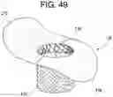 Fig. 44 - Prosthetic valves and related inventions