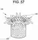 Fig. 52 - Prosthetic valves and related inventions