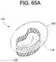 Fig. 60 - Prosthetic valves and related inventions