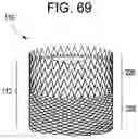 Fig. 65 - Prosthetic valves and related inventions