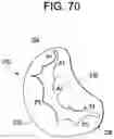Fig. 66 - Prosthetic valves and related inventions