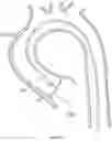 Fig. 38 - Stent apparatus having self-pleated skirt, processing method therefor, skirt pleating method, and cardiac valve