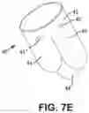 Fig. 08 - Implantable transcatheter intracardiac devices and methods for treating incompetent atrioventricular valves