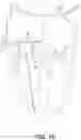 Fig. 11 - Implantable transcatheter intracardiac devices and methods for treating incompetent atrioventricular valves