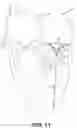 Fig. 12 - Implantable transcatheter intracardiac devices and methods for treating incompetent atrioventricular valves