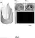 Fig. 09 - METHODS TO IMPROVE THE DURABILITY OF POLYMERIC HEART VALVES