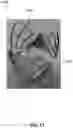 Fig. 18 - METHODS TO IMPROVE THE DURABILITY OF POLYMERIC HEART VALVES