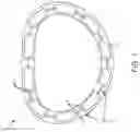 Fig. 02 - Annulus rings with suture clips