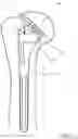 Fig. 05 - Rotatable collar for a prosthesis